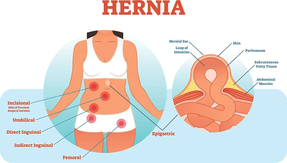 Laparoscopic Hernia Repair