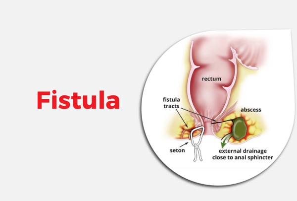Fistula Surgery