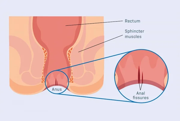 Fissure Surgery