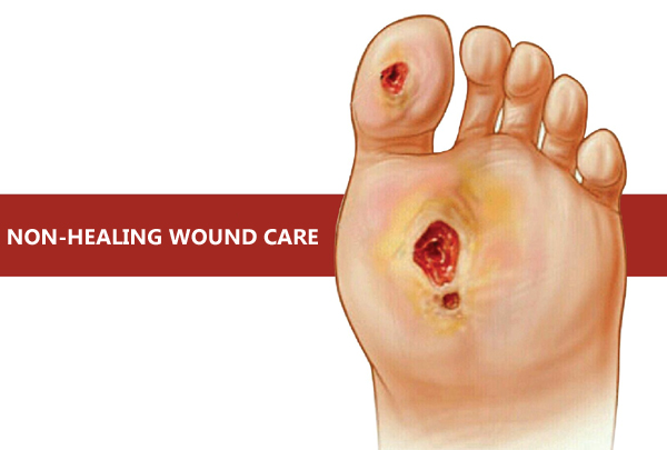 Non Healing Wound Care