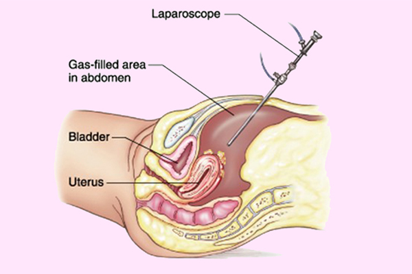 Hysteroscopy Laparoscopy Abdominal
